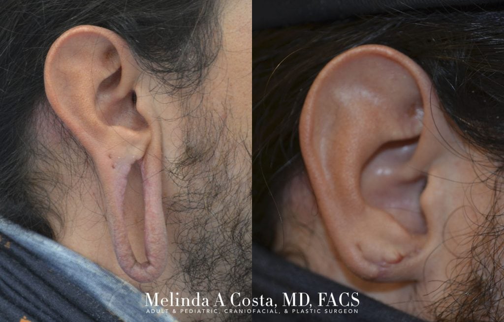 ear lobe repair ear surgery surgical repair stretched earlobes ear surgery before and after right ear post surgical san jose